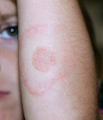 DSP Sibiu: 15 bolnavi de Lyme