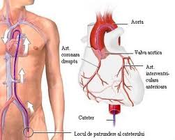 Angiografii gratuite la Polisano, în cadrul campaniei de prevenire a accidentelor vascular-cerebrale