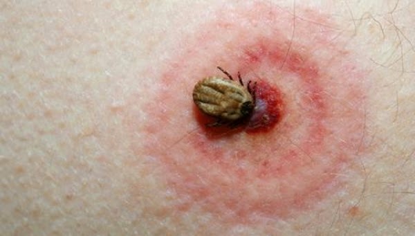 Record de sibieni intepati de capuse