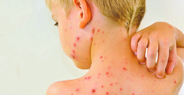 Opt decese din cauza rujeolei, în România. Săptămâna trecută au fost 777 de cazuri noi