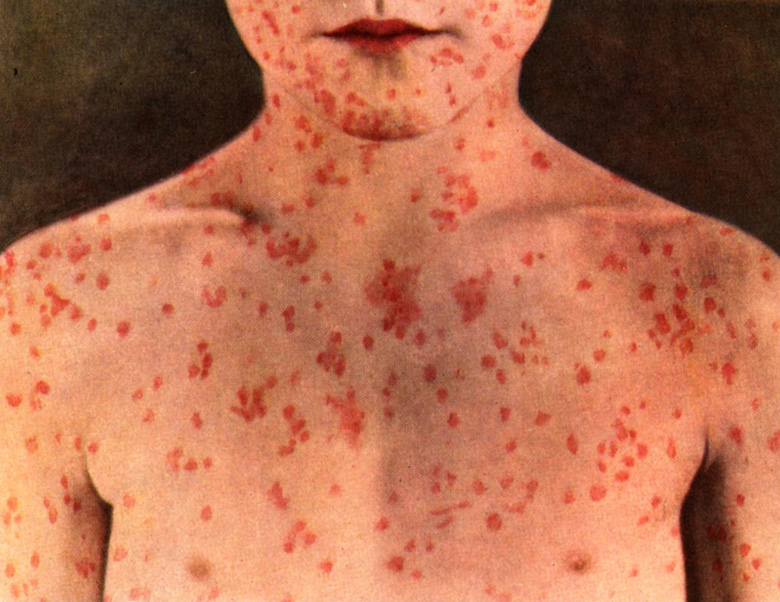 Aproape 2.500 de cazuri de rujeolă în acest an în România. 445 confirmate în ultima săptămână