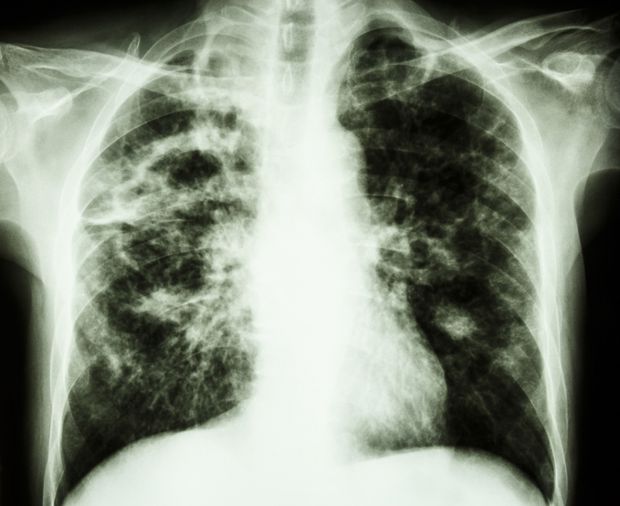 Suntem țara membră a UE cu cele mai multe cazuri noi de tuberculoză înregistrate