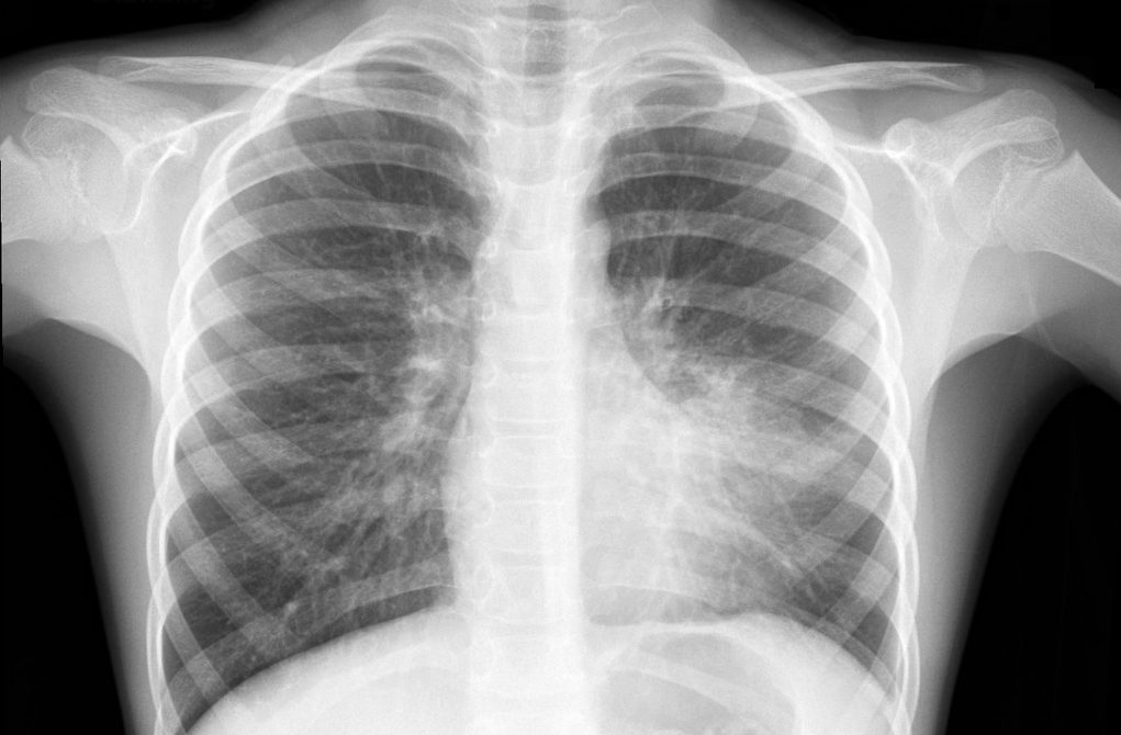 Îmbolnăviri cauzate de țigările electronice, la Timișoara