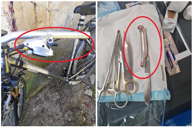 FOTO: Asta le întrece pe toate: un medic a cusut în rana unui tânăr mânerul frânei de la bicicletă