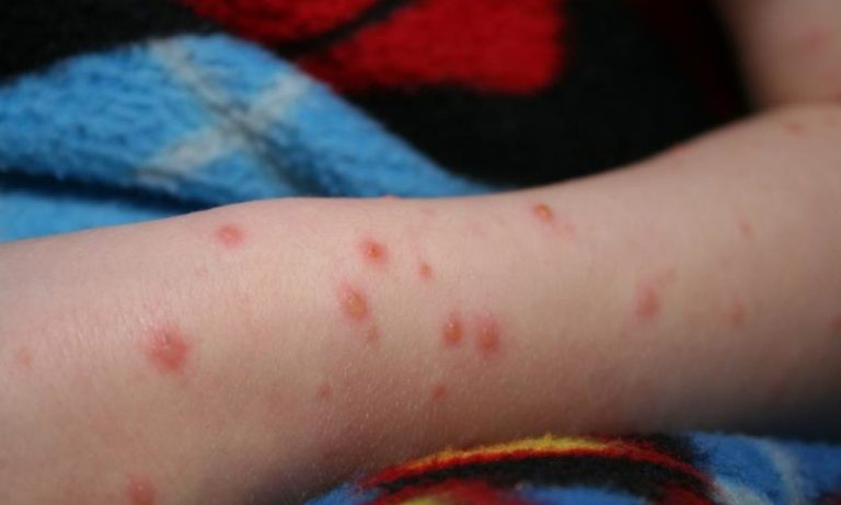 Încă două decese din cauza rujeolei, în România