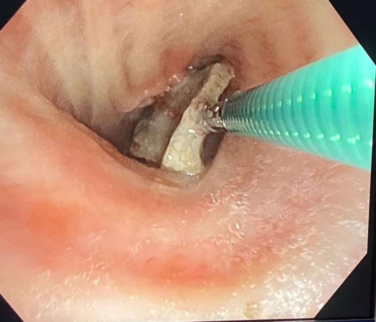 FOTO: Os de peste un centimetru extras din plămânul unui pacient la Spitalul de Pneumoftiziologie Sibiu