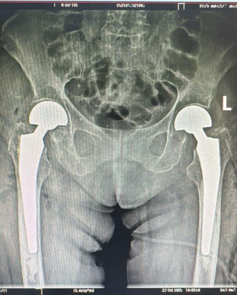 FOTO: Intervenție în premieră la Spitalul Județean Sibiu. Artroplastie parțială de șold bilateral