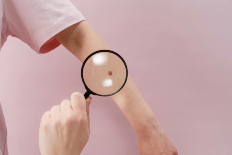 Plasture inteligent pentru melanom: tratament inovator fără operație