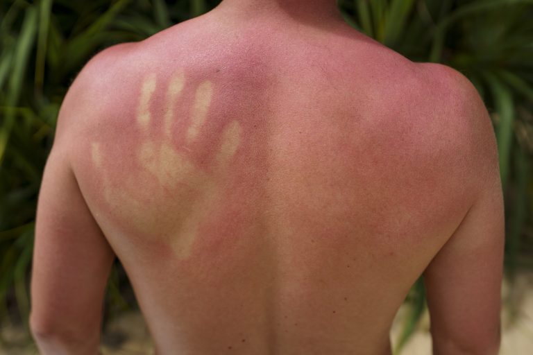 Afecțiunile dermatologice pe care soarele le trezește la viață