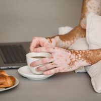 Descoperire științifică: Pastila zilnică ce ar putea reda pigmentul pielii în vitiligo