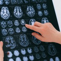 Ziua Mondială a AVC: simptomele care impun apelul la 112